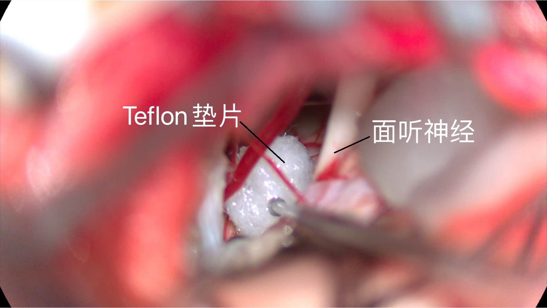 华安脑科医院成功开展首例面肌痉挛显微血管减压术 华安脑科医院成功开展首例面肌痉挛显微血管减压术