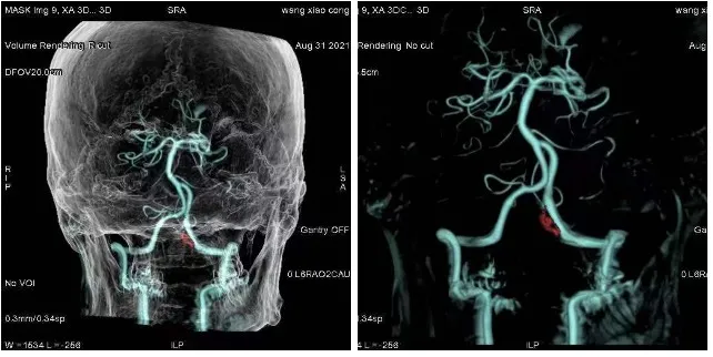 双板DSA脑部3D动态图 双板DSA脑部3D动态图